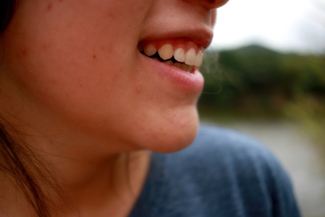 smiling girl having acne on her face