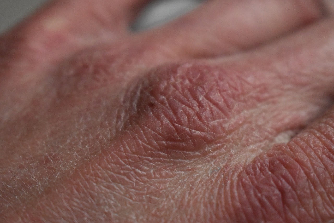 a hand with dry skin