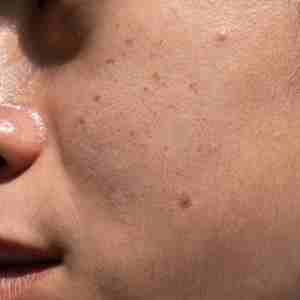 a woman's face with dark spots