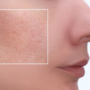 a woman's face with magnified area of clogged pores